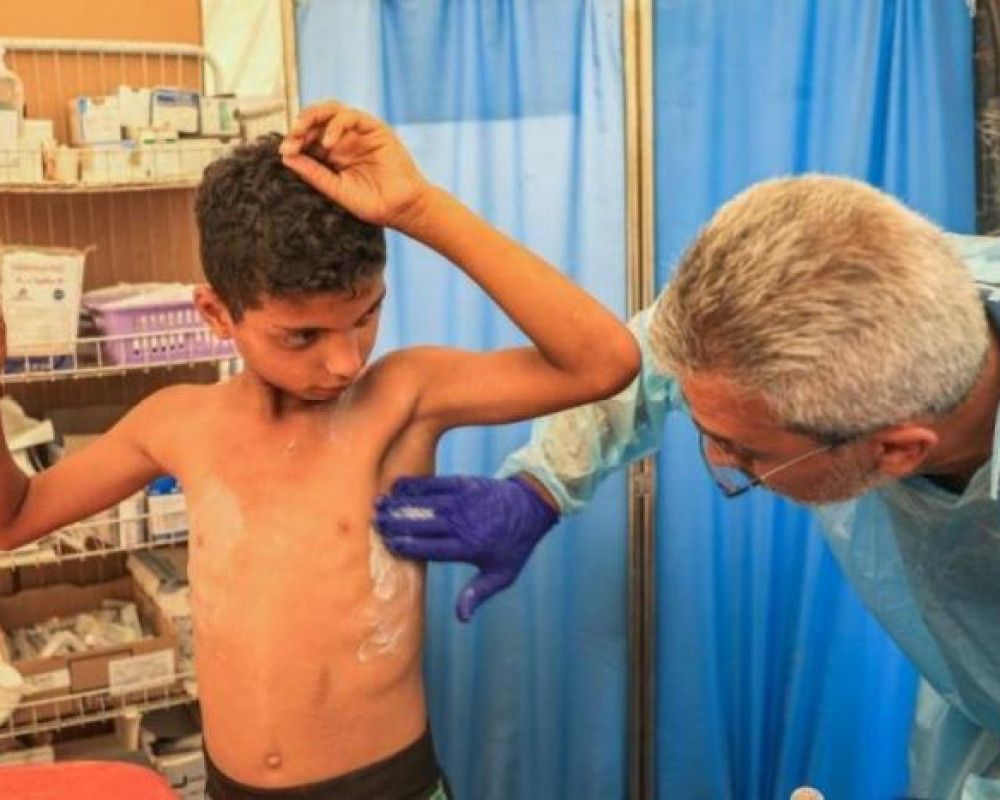 الأمم المتحدة تُحذر من تفشٍ واسع لـ "جدري الماء" يُهدد النازحين في قطاع غزة
