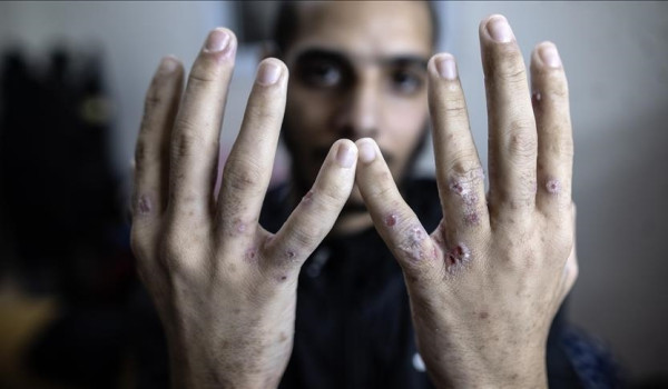 تفاقم انتشار الجرب في سجن جلبوع وتصاعد ا...