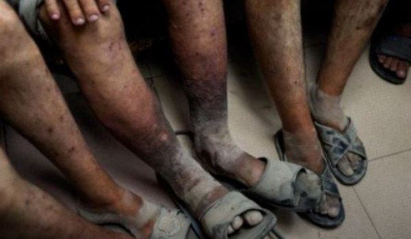 Scabies Outbreak Spreads Across Palestin...